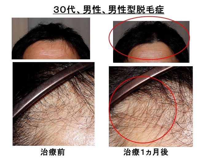 円形脱毛症　病院